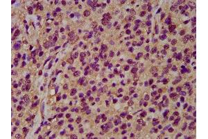 IHC image of ABIN7161362 diluted at 1:200 and staining in paraffin-embedded human glioma performed on a Leica BondTM system. (NrCAM antibody  (AA 1194-1299))