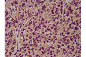 IHC image of ABIN7161362 diluted at 1:200 and staining in paraffin-embedded human glioma performed on a Leica BondTM system.