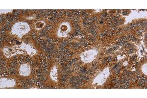 Immunohistochemistry of paraffin-embedded Human colon cancer using HSD17B4 Polyclonal Antibody at dilution of 1:30 (HSD17B4 antibody)