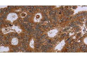 Immunohistochemistry of paraffin-embedded Human colon cancer using HSD17B4 Polyclonal Antibody at dilution of 1:30
