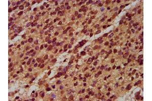 IHC image of ABIN7160831 diluted at 1:400 and staining in paraffin-embedded human glioma performed on a Leica BondTM system. (NLRP6 antibody  (AA 154-306))