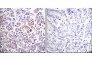 Immunohistochemistry analysis of paraffin-embedded human breast carcinoma tissue, using C-RAF (Ab-296) Antibody. (RAF1 antibody  (AA 271-320))