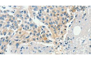Immunohistochemistry of paraffin-embedded Human breast cancer tissue using DGK beta Polyclonal Antibody at dilution 1:60 (DGKB antibody)