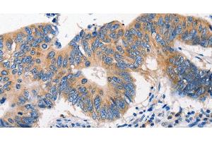 Immunohistochemistry of paraffin-embedded Human colon cancer tissue using MTOR Polyclonal Antibody at dilution 1:60 (MTOR antibody)