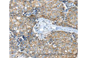 Immunohistochemistry of Human colon cancer using IFNA2 Polyclonal Antibody at dilution of 1:40