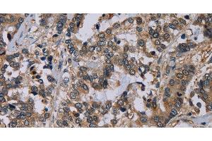 Immunohistochemistry of paraffin-embedded Human liver cancer using NECTIN4 Polyclonal Antibody at dilution of 1:60 (PVRL4 antibody)
