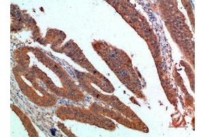 Immunohistochemical analysis of paraffin-embedded human-colon-cancer, antibody was diluted at 1:200 (PDGFC antibody  (AA 61-110))