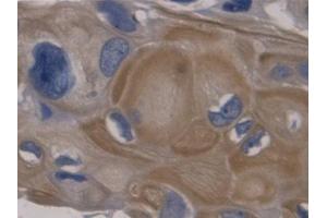DAB staining on IHC-P; Samples: Human Colorectal cancer Tissue (GDF11 antibody  (AA 138-386))