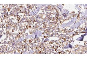 ABIN6276766 at 1/100 staining Human Melanoma tissue by IHC-P. (SPARC antibody  (Internal Region))