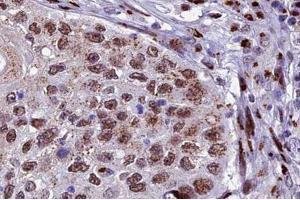 ABIN6266678 at 1/100 staining human lung carcinoma tissue sections by IHC-P. (XRCC3 antibody  (N-Term))