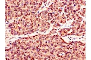 Immunohistochemistry of paraffin-embedded human ovarian cancer using ABIN7146893 at dilution of 1:100 (CSNK2B antibody  (AA 1-215))