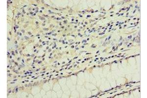 Immunohistochemistry of paraffin-embedded human colon cancer using ABIN7154311 at dilution of 1:100 (GS28 antibody  (AA 1-115))