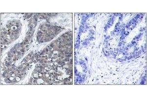 Immunohistochemistry analysis of paraffin-embedded human breast carcinoma tissue, using PYK2 (Ab-402) Antibody. (PTK2B antibody  (AA 369-418))
