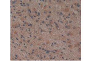 Detection of NOG in Human Glioma Tissue using Monoclonal Antibody to Noggin (NOG) (NOG antibody  (AA 28-232))
