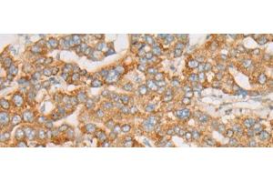 Immunohistochemistry of paraffin-embedded Human liver cancer tissue using ATXN7 Polyclonal Antibody at dilution of 1:60(x200) (ATXN7 antibody)