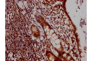 IHC image of ABIN7127450 diluted at 1:100 and staining in paraffin-embedded human colon cancer performed on a Leica BondTM system. (Recombinant DDX5 antibody)