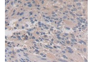 Detection of CAPN3 in Human Lung cancer Tissue using Polyclonal Antibody to Calpain 3 (CAPN3) (Calpain 3 antibody  (AA 602-821))
