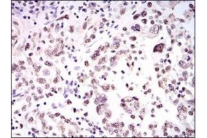 Immunohistochemical analysis of paraffin-embedded human endometrial cancer tissues using HNRNPU mouse mAb with DAB staining.