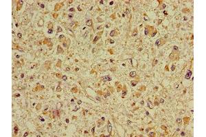 Immunohistochemistry of paraffin-embedded human glioma using ABIN7149930 at dilution of 1:100 (DPYSL2 antibody  (AA 1-572))