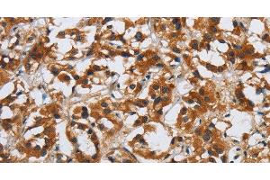 Immunohistochemistry of paraffin-embedded Human thyroid cancer tissue using DSP Polyclonal Antibody at dilution 1:40 (Desmoplakin antibody)