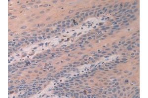 Detection of ATF4 in Human Stomach cancer Tissue using Polyclonal Antibody to Activating Transcription Factor 4 (ATF4) (ATF4 antibody  (AA 130-347))