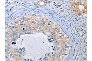 The image on the left is immunohistochemistry of paraffin-embedded Human cervical cancer tissue using ABIN7128287(AGBL5 Antibody) at dilution 1/30, on the right is treated with fusion protein. (AGBL5 antibody)