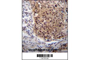 EXTL3 Antibody immunohistochemistry analysis in formalin fixed and paraffin embedded human esophageal carcinoma followed by peroxidase conjugation of the secondary antibody and DAB staining. (EXTL3 antibody  (N-Term))