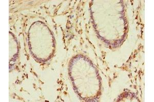Immunohistochemistry of paraffin-embedded human colon cancer using ABIN7172979 at dilution of 1:100 (TMED3 antibody  (AA 24-180))