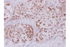 IHC-P Image STMN2 antibody detects STMN2 protein at cytoplasm on human liver carcinoma by immunohistochemical analysis. (STMN2 antibody  (N-Term))