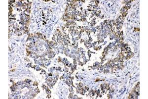 IHC testing of FFEP human lung cancer tissue with Periplakin antibody at 1ug/ml. (PPL antibody  (AA 1664-1701))