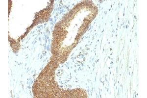 Formalin-fixed, paraffin-embedded human Colon Carcinoma stained with Alkaline Phosphatase Mouse Monoclonal Antibody (ALPL/597). (ALPL antibody)