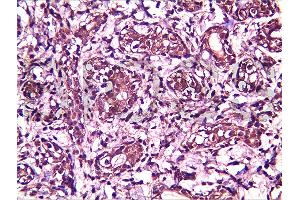 Formalin-fixed and paraffin embedded human breast carcinoma labeled with Anti-BRMS-1 Polyclonal Antibody, Unconjugated (ABIN730933) at 1:200, followed by conjugation to the secondary antibody and DAB staining (BRMS1L antibody  (AA 151-246))