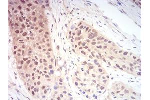 Immunohistochemical analysis of paraffin-embedded esophageal cancer tissues using RAN mouse mAb with DAB staining. (RAN antibody  (AA 1-216))