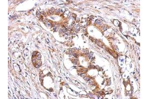 IHC-P Image Immunohistochemical analysis of paraffin-embedded human gastric cancer, using LHR, antibody at 1:500 dilution. (LHCGR antibody  (C-Term))