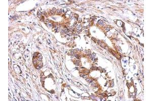 IHC-P Image Immunohistochemical analysis of paraffin-embedded human gastric cancer, using LHR, antibody at 1:500 dilution.