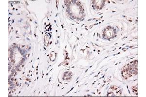 Immunohistochemical staining of paraffin-embedded breast using anti-Nog (ABIN2452676) mouse monoclonal antibody.