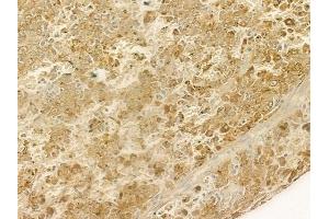 ABIN6259900 and ABIN6276494 at 1/100 staining human melanoma by IHC-P.