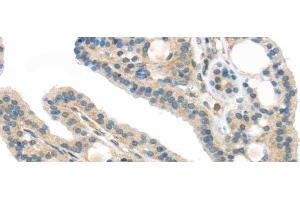Immunohistochemistry of paraffin-embedded Human thyroid cancer using VPS26A Polyclonal Antibody at dilution of 1/40 (VPS26A antibody)
