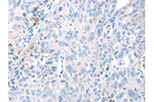 The image on the left is immunohistochemistry of paraffin-embedded Human ovarian cancer tissue using ABIN7130139(MAGEB4 Antibody) at dilution 1/40, on the right is treated with fusion protein. (MAGEB4 antibody)