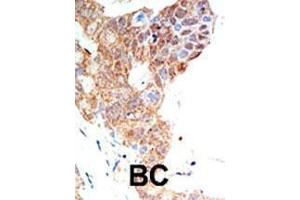 Formalin-fixed and paraffin-embedded human cancer tissue reacted with the primary antibody, which was peroxidase-conjugated to the secondary antibody, followed by DAB staining. (PRMT5 antibody  (C-Term))
