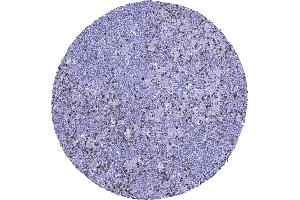 Hodgkins lymphoma containing numerous reactive CTLA 4 positive lymphocytes (Recombinant CTLA4 antibody)