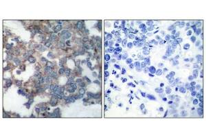 Immunohistochemical analysis of paraffin-embedded human breast carcinoma tissue using p70 S6 Kinase(Phospho-Ser424) Antibody(left) or the same antibody preincubated with blocking peptide(right). (RPS6KB1 antibody  (pSer424))