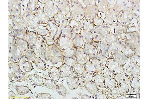 Formalin-fixed and paraffin embedded human colon carcinoma tissue labeled with Rabbit Anti-RAB7 Polyclonal Antibody (ABIN720191) at 1:200 followed by conjugation to the secondary antibody and DAB staining.