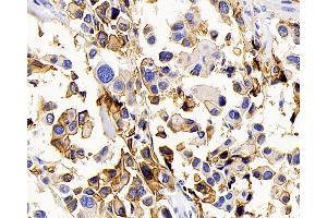 Immunohistochemistry analysis of paraffin-embedded human lung cancer using AQP1 Polyclonal Antibody at dilution of 1:400. (Aquaporin 1 antibody)