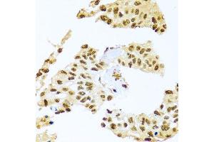 Immunohistochemistry of paraffin-embedded human lung cancer using SMEK1 antibody (ABIN5974870) at dilution of 1/100 (40x lens).