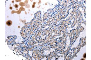 Immunohistochemistry of Human stomach cancer using UTS2 Polyclonal Antibody at dilution of 1:100 (Urotensin 2 antibody)