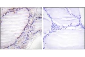 Immunohistochemistry analysis of paraffin-embedded human thyroid gland, using Fos (Phospho-Ser362) Antibody. (c-FOS antibody  (pSer362))