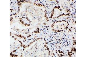 IHC-P: Lamin A/C antibody testing of human lung cancer tissue (Lamin A/C antibody  (AA 455-469))