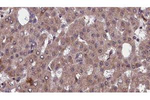 ABIN6277556 at 1/100 staining Human liver cancer tissue by IHC-P. (PVRL2 antibody  (Internal Region))