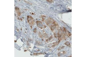 Immunohistochemical staining (Formalin-fixed paraffin-embedded sections) of human breast cancer with PHGDH monoclonal antibody, clone CL0555  shows moderate cytoplasmic immunoreactivity in tumor cells. (PHGDH antibody)